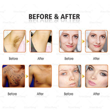 Load image into Gallery viewer, 3 in 1 OPT Hair Removal + RF + ND YAG Laser Tattoo Removal Machine Laser Hair Removal Machine Price