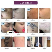 Load image into Gallery viewer, Pigment Treatment Laser Tattoo Removal Machine Skin Care Q-Switch Laser for Tattoo/Pigment/Acne/Mole Removal Laser Beauty Salon Equipment
