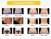 Load image into Gallery viewer, Niansheng Factory professional Silicone Cryo handles chin lifting 40K cavitation RF fat freeze cryo slimming machine