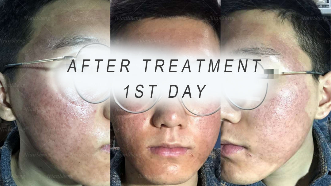 Why is CO2 fractional laser a good treatment for acne pits?