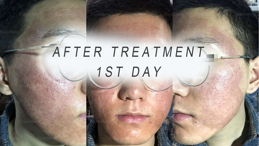 Why is CO2 fractional laser a good treatment for acne pits?