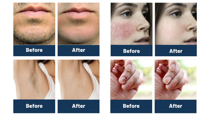 Alexandrite 755+1064NM Long Pulse Nd:YAG Laser hair removal machine