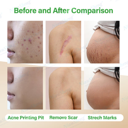 CE Approved Portable CO2 Fractional Laser: Commercial Beauty Machine for Vaginal Tightening & Skin Resurfacing