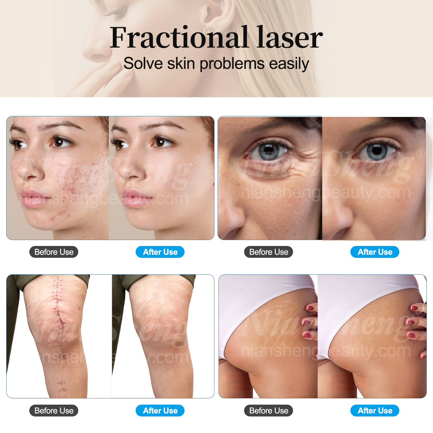 Niansheng Scar Removal Skin Tighten Acne Treatment Co2 Laser Skin Resurfacing Co2 Fractional Laser Machine