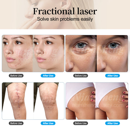 Niansheng Scar Removal Skin Tighten Acne Treatment Co2 Laser Skin Resurfacing Co2 Fractional Laser Machine