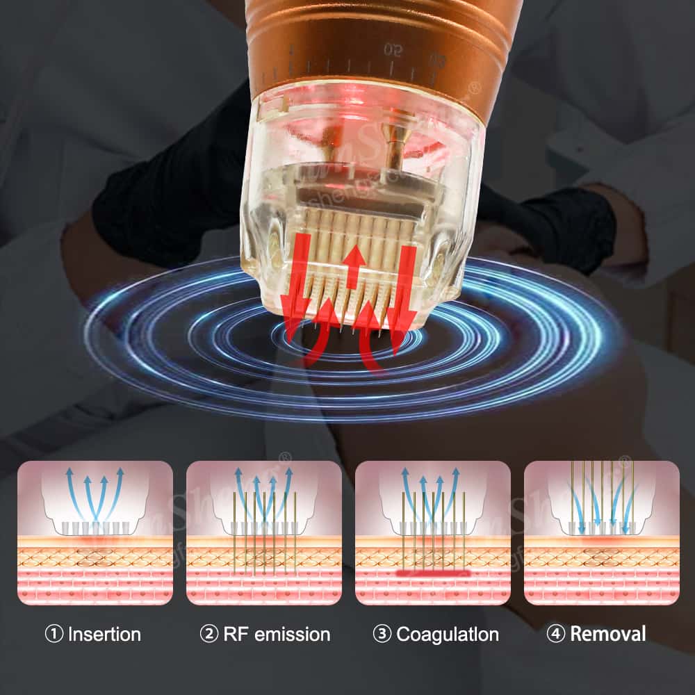 A Niansheng RF Microneedle Portable Fractional Radio Frequency Skin Tightening Scarlet Rf Microneedling Machine