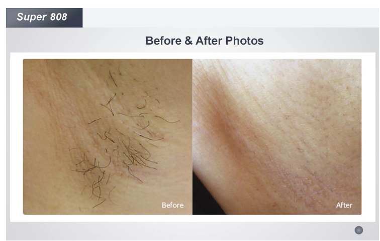 Ice Platinum 808nm Diode Laser Hair Removal 808 Diodo Depilation Facial Beauty Salon Machine