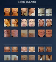 Load image into Gallery viewer, Portable Hifu 7D Hifu Focused Ultrasound Machine For Wrinkle Removal
