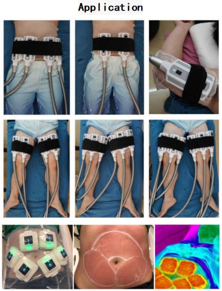 fat reduce monopolar id