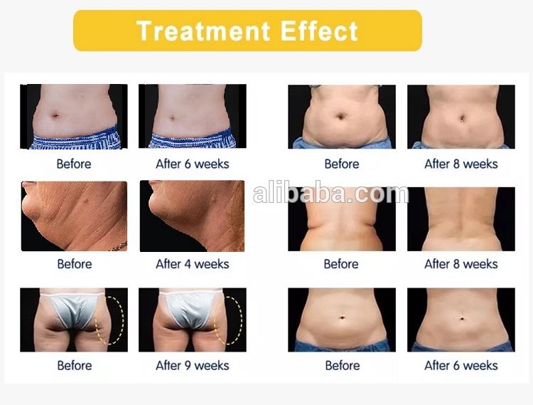 Niansheng Factory professional Silicone Cryo handles chin lifting 40K cavitation RF fat freeze cryo slimming machine